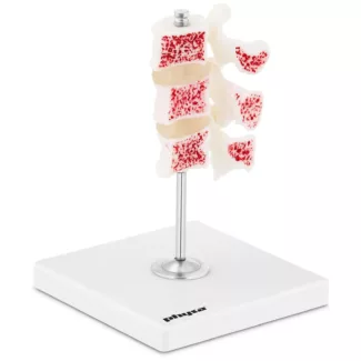 Anatominen malli lannenikamien kulumisesta – väritetty