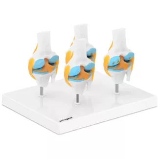 Polven malli – neljä nivelrikon vaihetta – puolikas pienennys